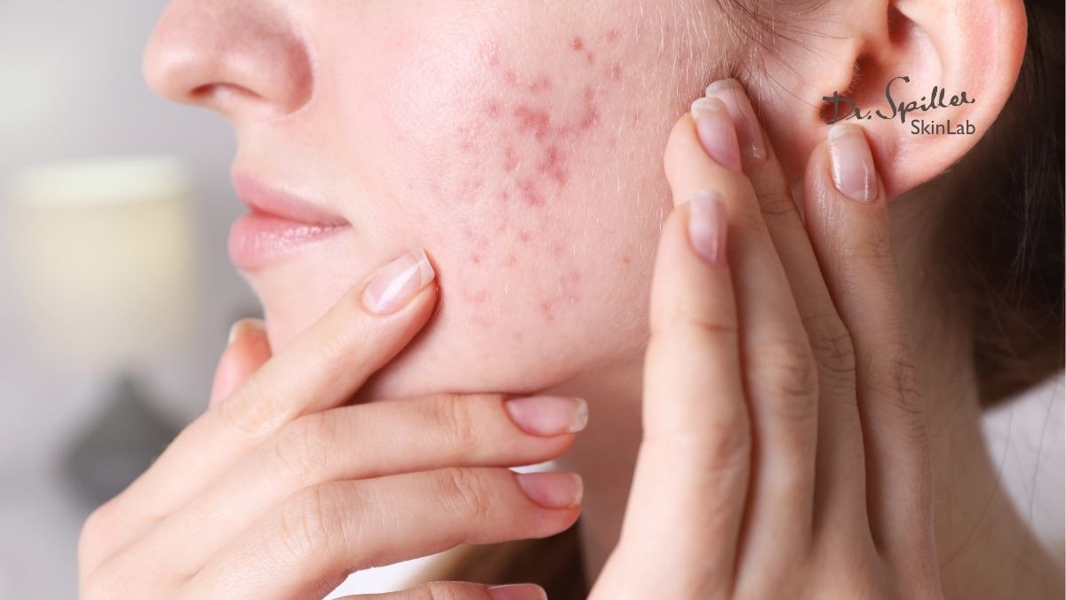 Vai trò của nước hoa hồng trong chu trình chăm sóc da mụn nhạy cảm