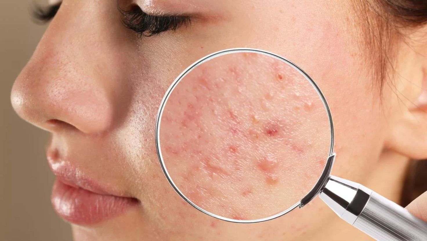 Sản phẩm skincare cho da dầu mụn nhạy cảm hiệu quả