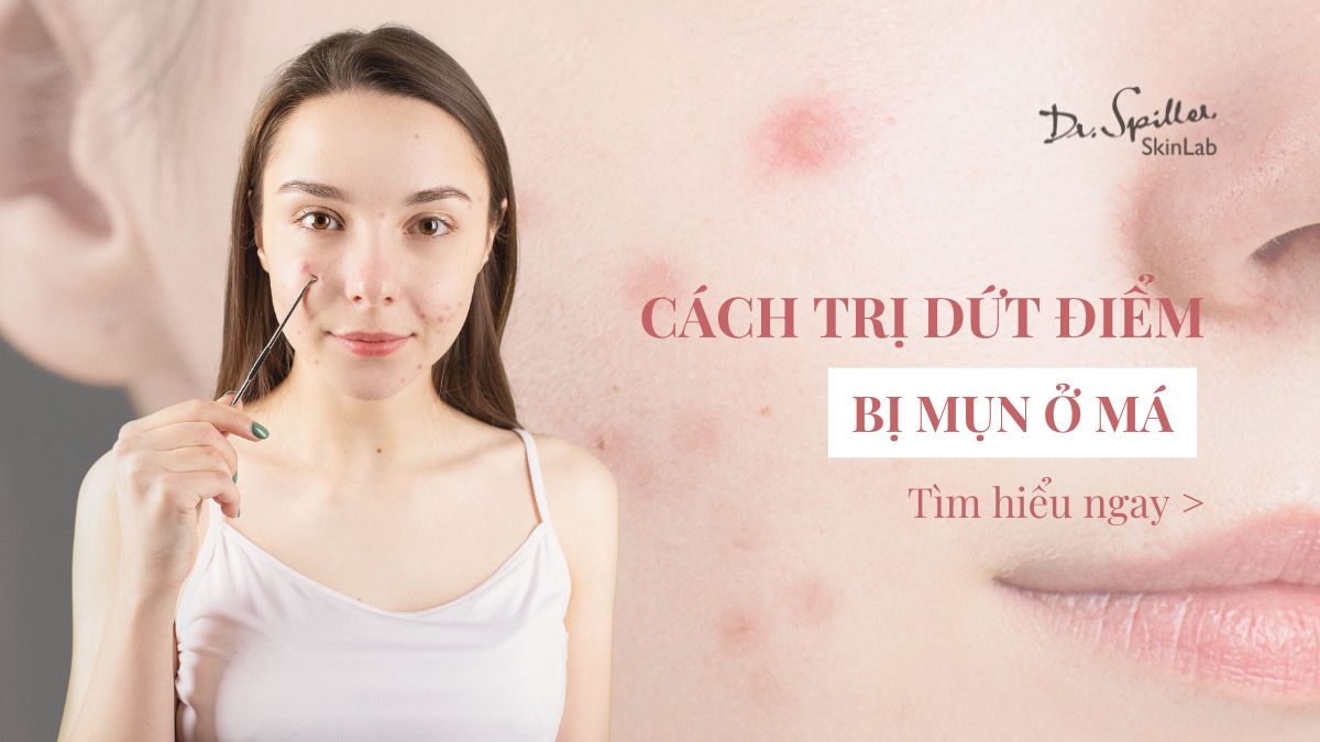 Bị mụn ở má: Nguyên nhân & cách trị dứt điểm hiệu quả
