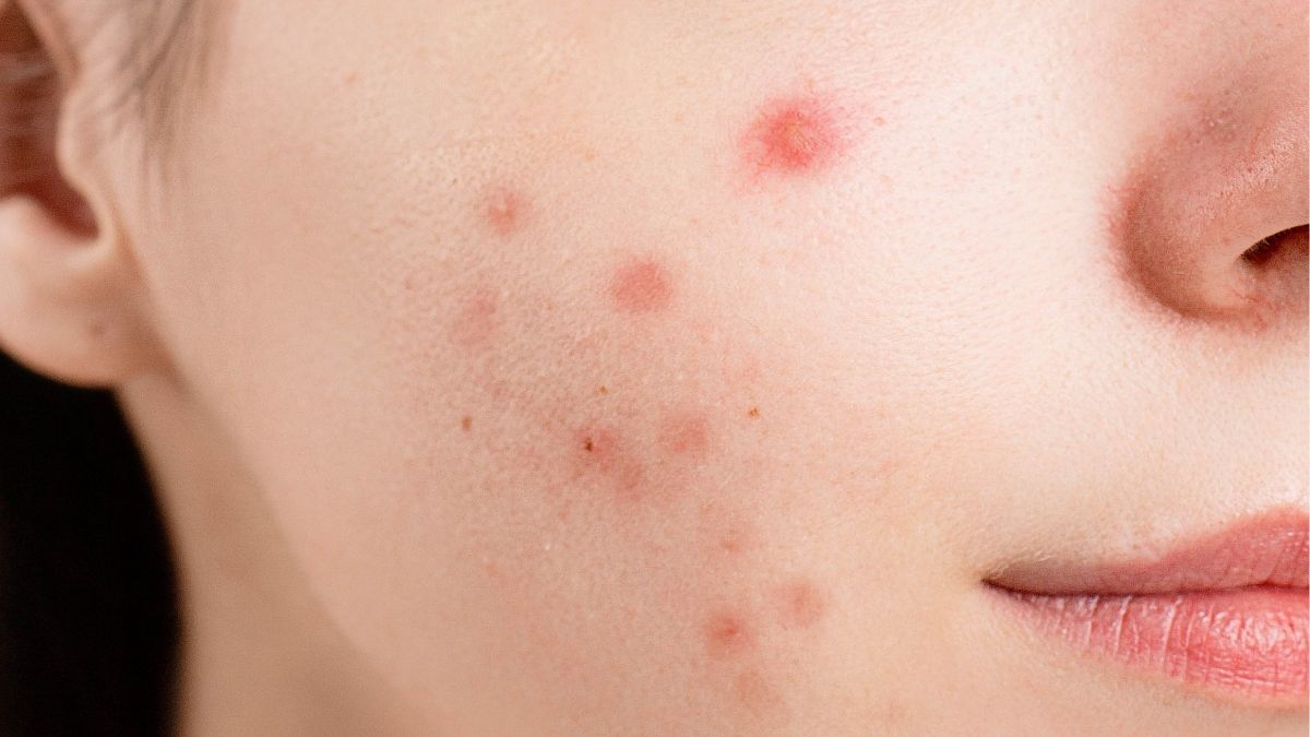 Mụn ở má phải – vấn đề từ phổi và hệ hô hấp