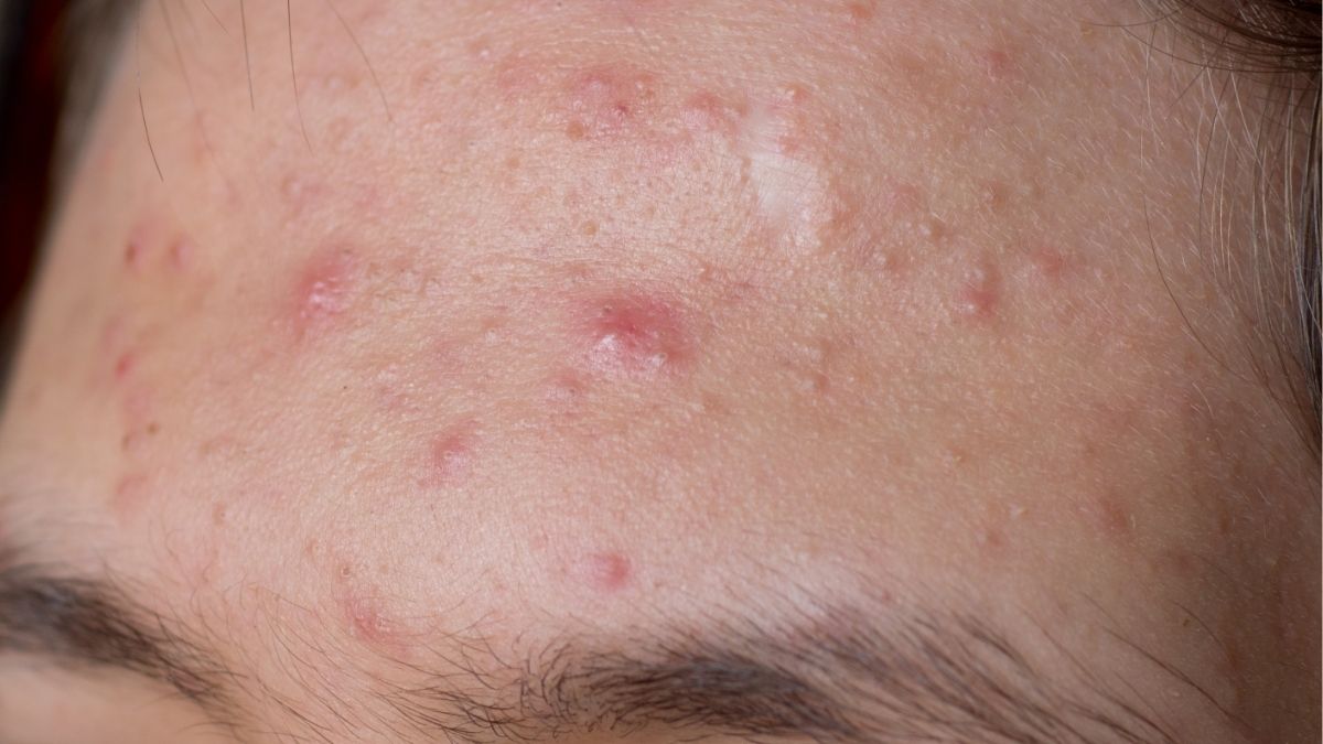 Nguyên nhân gây ra mụn viêm – Hiểu rõ để điều trị đúng cách