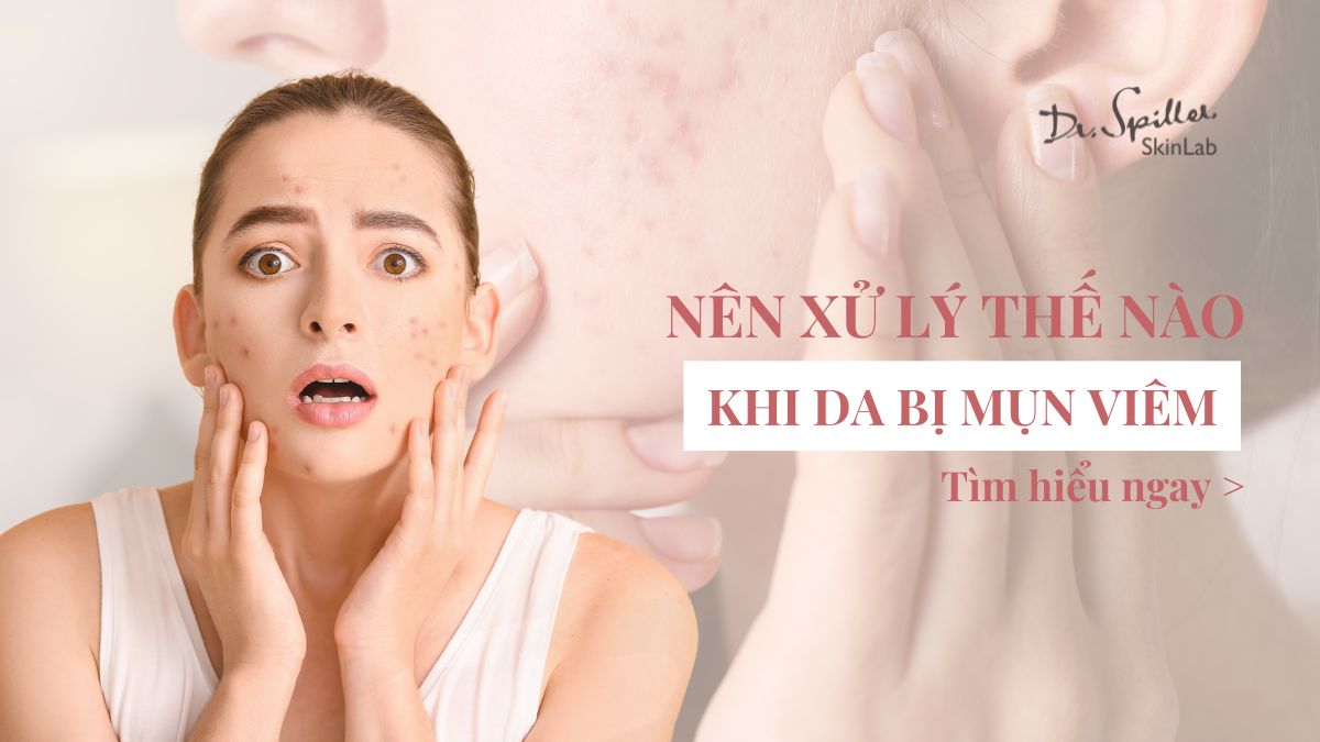 Bị mụn viêm nên làm gì? Hướng dẫn 4 cách cải thiện bạn cần biết