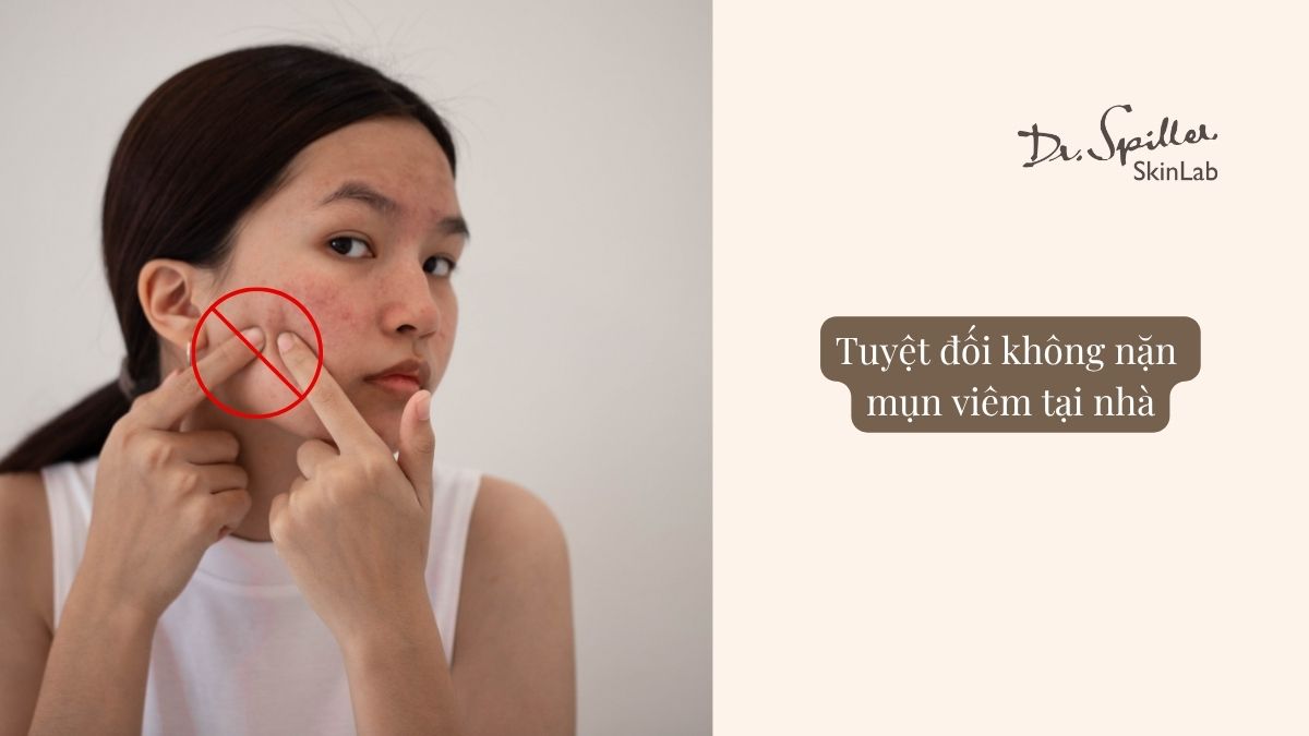 Hành động nặn mụn không đúng cách có thể làm vi khuẩn lan rộng
