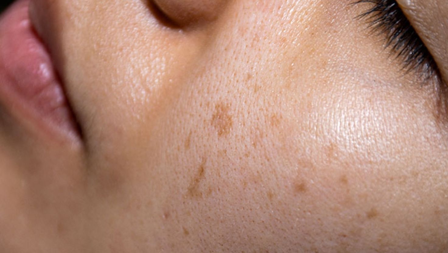 Nguyên nhân phổ biến khiến da bị nổi đốm đen