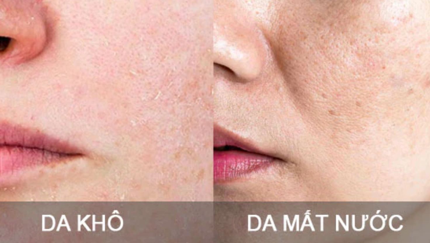 Lợi ích của việc xông hơi mặt đúng cách: Da khô và da mất nước 