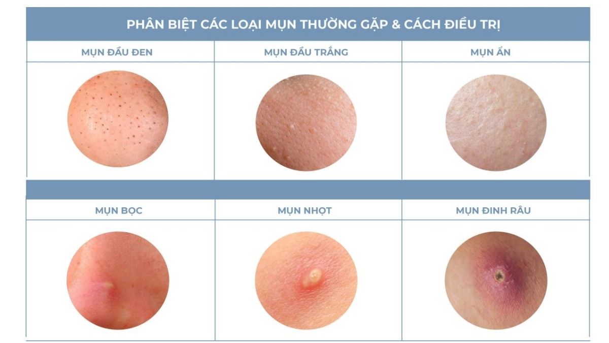 Phân loại các loại mụn trên mặt phổ biến nhất