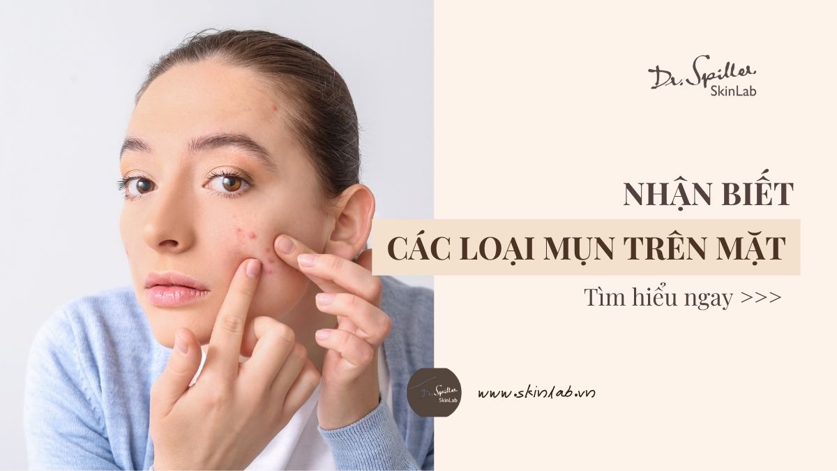 Các loại mụn trên mặt: Nhận biết và điều trị đúng cách