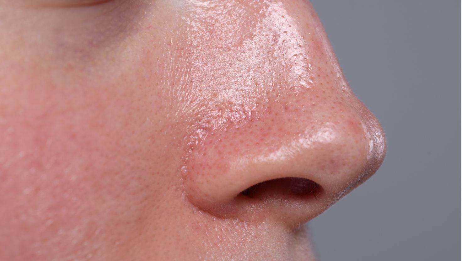 Mách bạn 2 cách giảm da dầu hiệu quả, an toàn và duy trì lâu dài