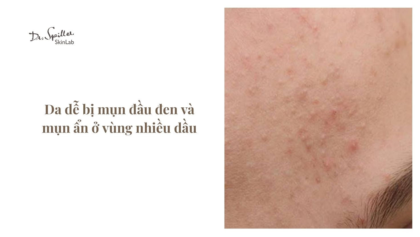 Đặc điểm của da hỗn hợp thiên dầu