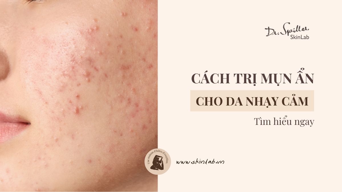 Cách trị mụn ẩn cho da nhạy cảm