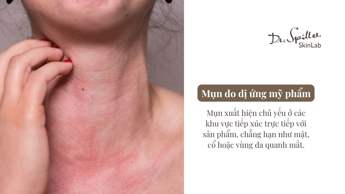 Cách nhận diện và xử lý mụn do dị ứng mỹ phẩm