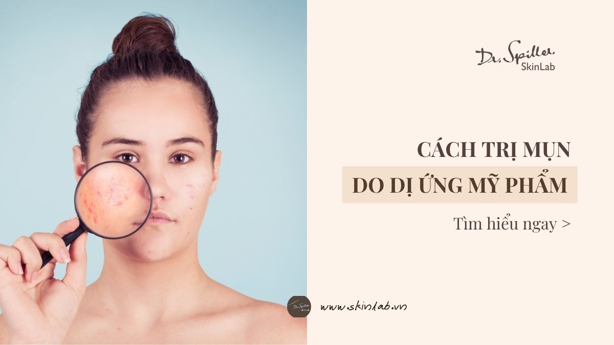 cach-tri-mun-khi-bi-di-ung-my-pham