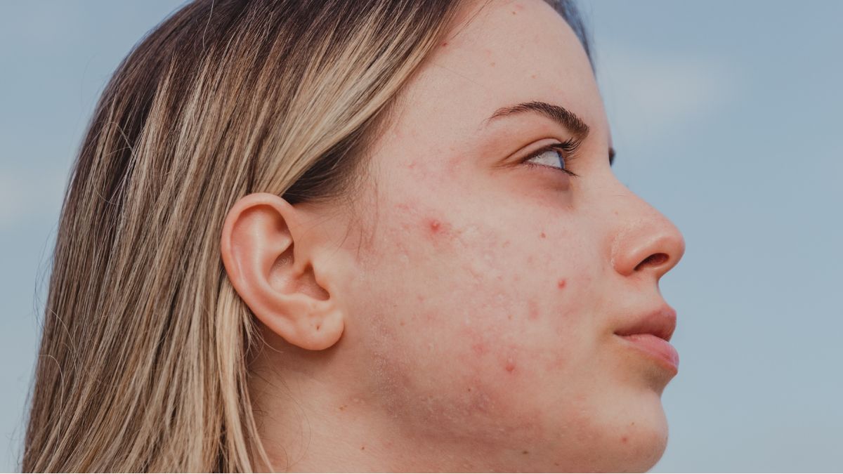 Cách Chăm Sóc Da Mặt Vào Mùa Mưa Hiệu Quả, Đúng Chuẩn