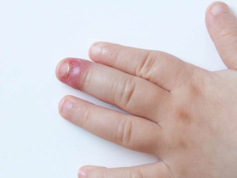 Chín mé (tên tiếng Anh là Paronychia) là tình trạng nhiễm trùng ở vùng da quanh móng