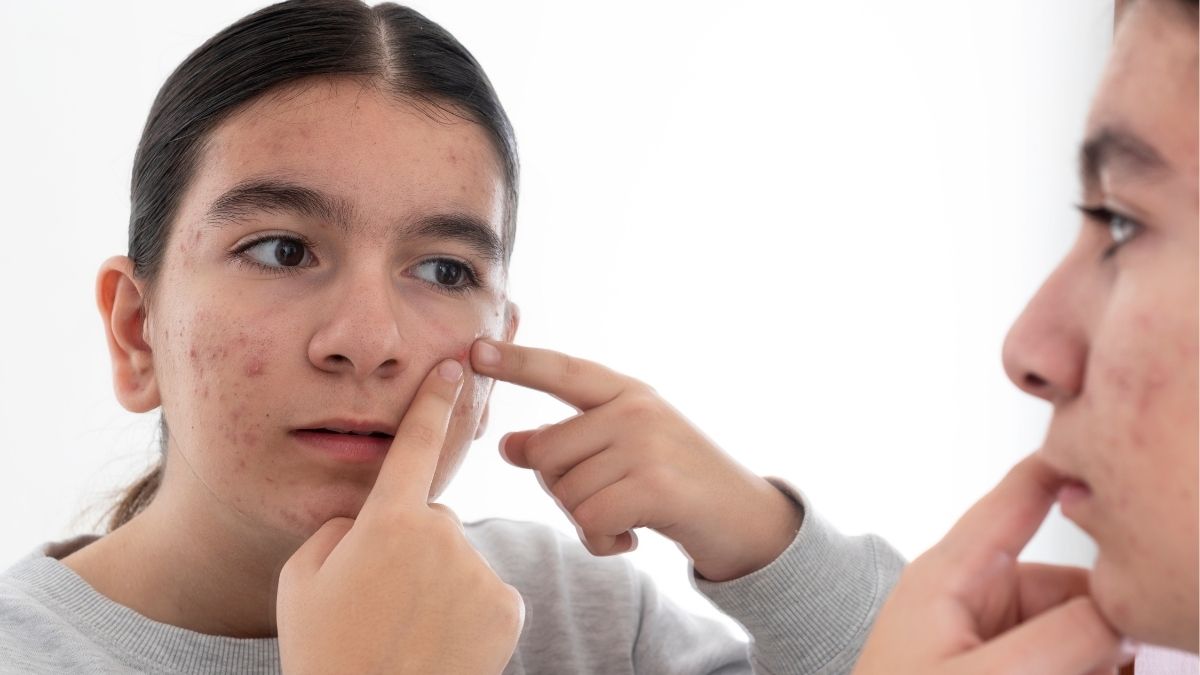 Vì sao tuổi teen cần có chu trình dưỡng da riêng?