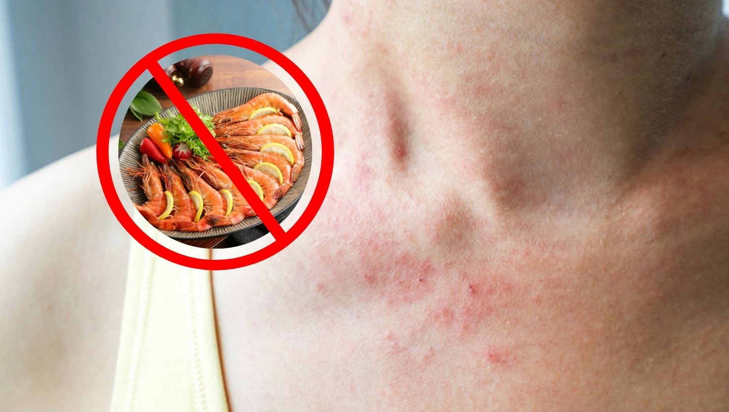 Một số loại thực phẩm có thể gây ra phản ứng dị ứng da, đặc biệt là với những người có cơ địa nhạy cảm