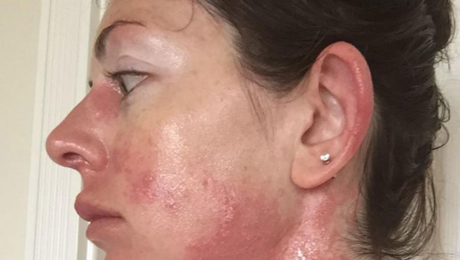 Da bị dị ứng do đâu? Tìm hiểu 4 nguyên nhân gây dị ứng da