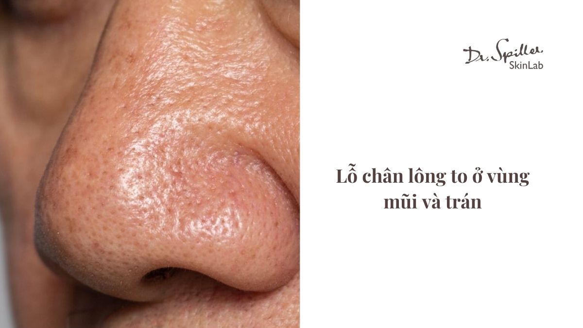 Đặc điểm của làn da hỗn hợp thiên dầu