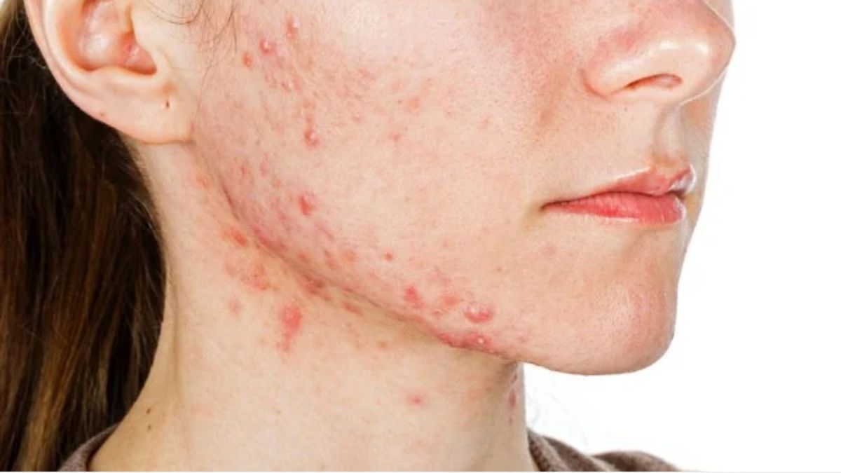 Tác dụng của kẽm trong điều trị mụn nội tiết