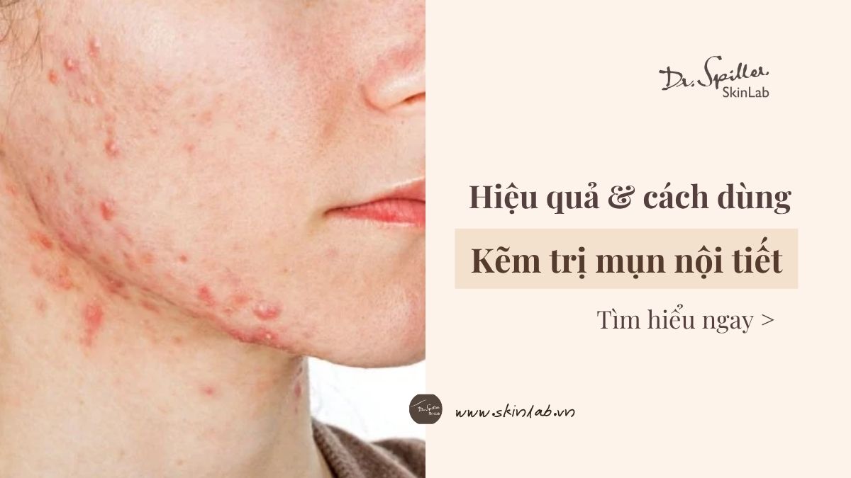 Kẽm trị mụn nội tiết