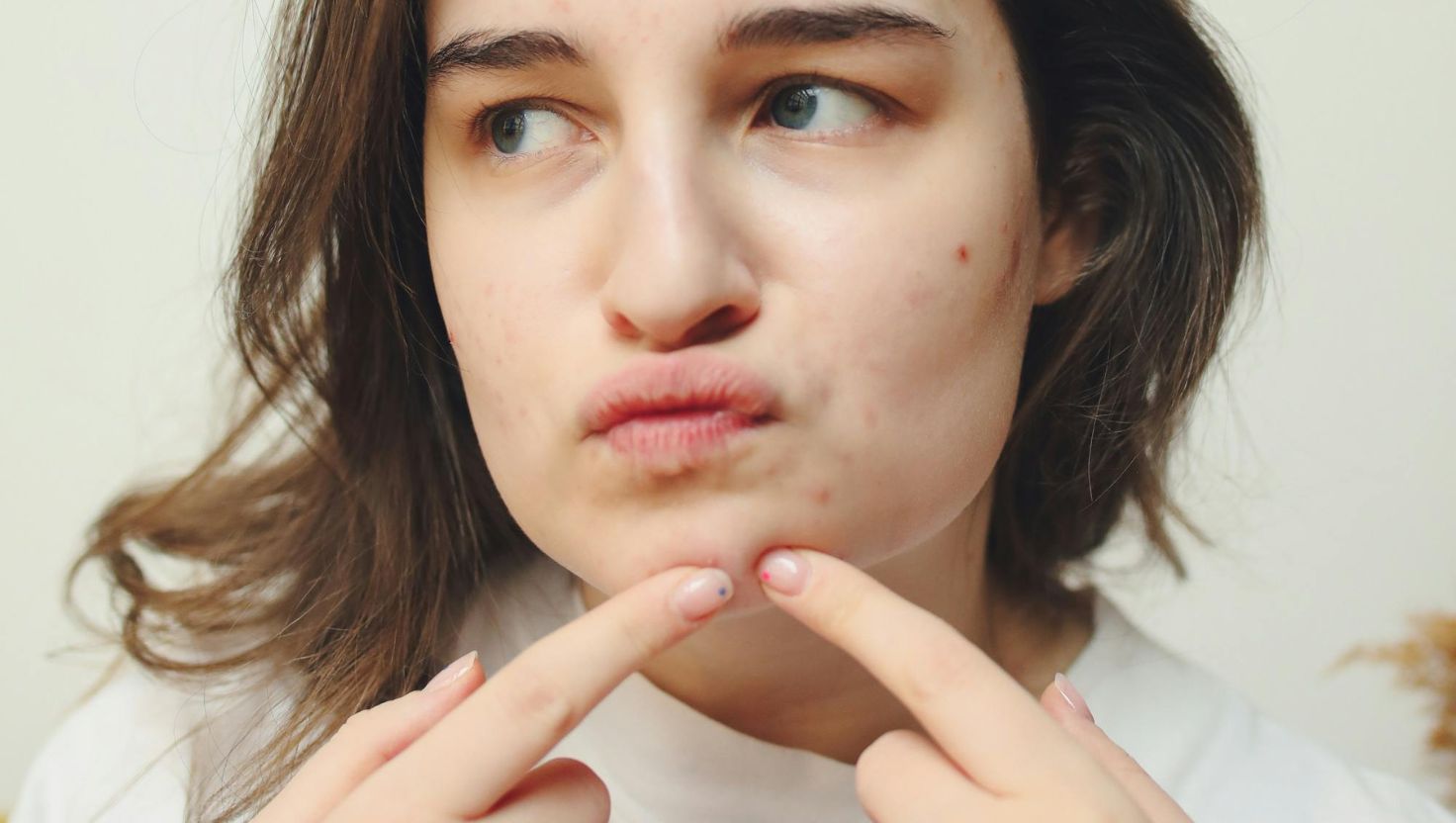 Nguyên nhân phổ biến gây mụn bọc ở cằm