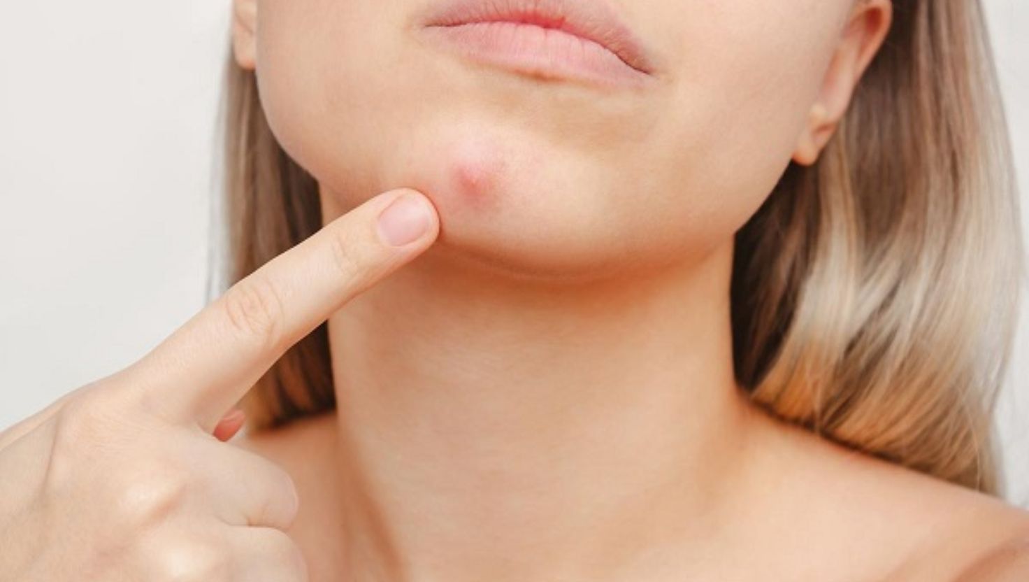 Dấu hiệu nhận biết mụn bọc ở cằm