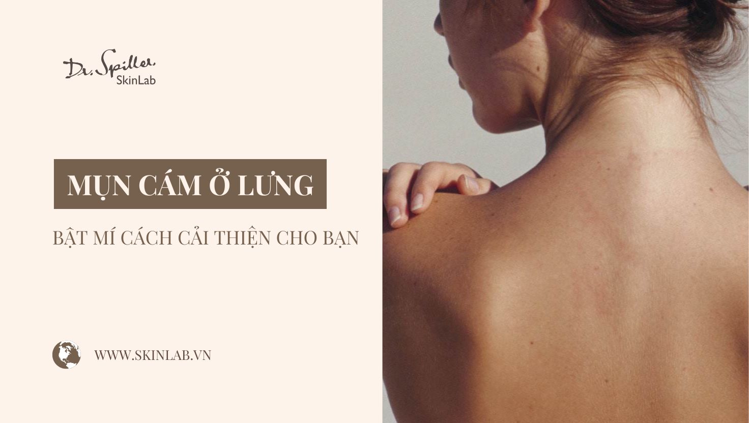 Nguyên nhân phổ biến gây mụn cám ở lưng