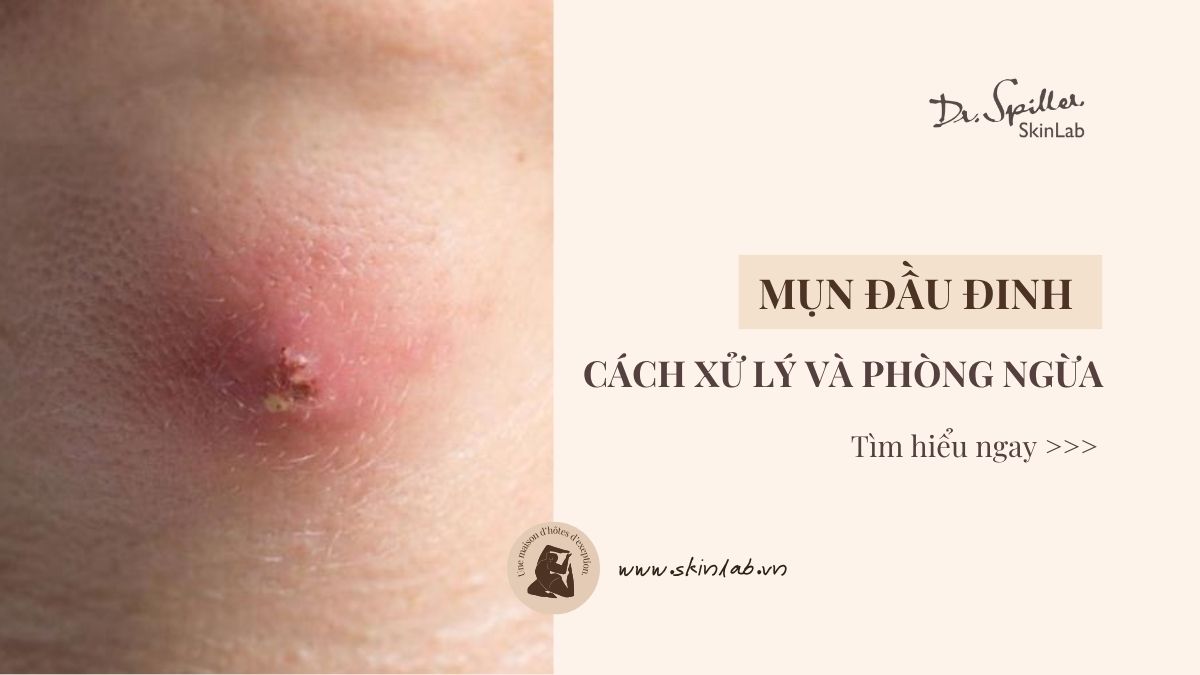 Mụn đầu đinh có nguy hiểm không? Cách xử lý và phòng ngừa
