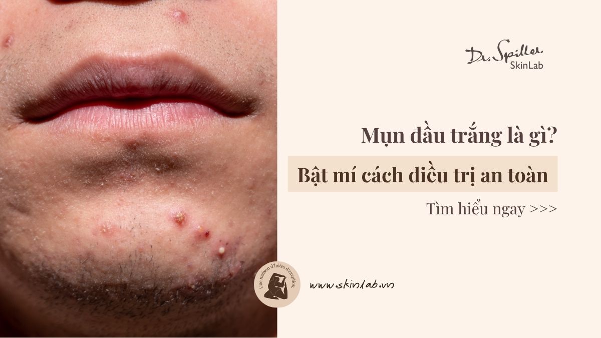 Mụn đầu trắng là gì? 5 dấu hiệu nhận biết và cách điều trị an toàn