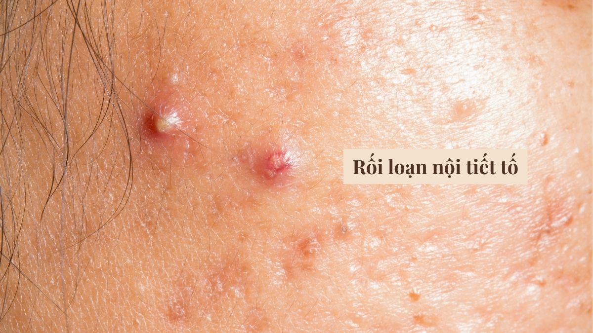 Rối loạn nội tiết tố là nguyên nhân gây ra mụn đầu trắng