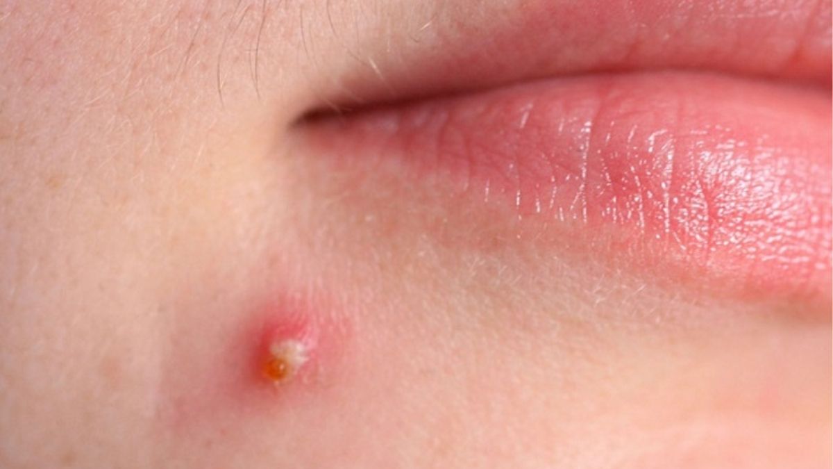 Dấu hiệu nhận biết mụn đầu trắng