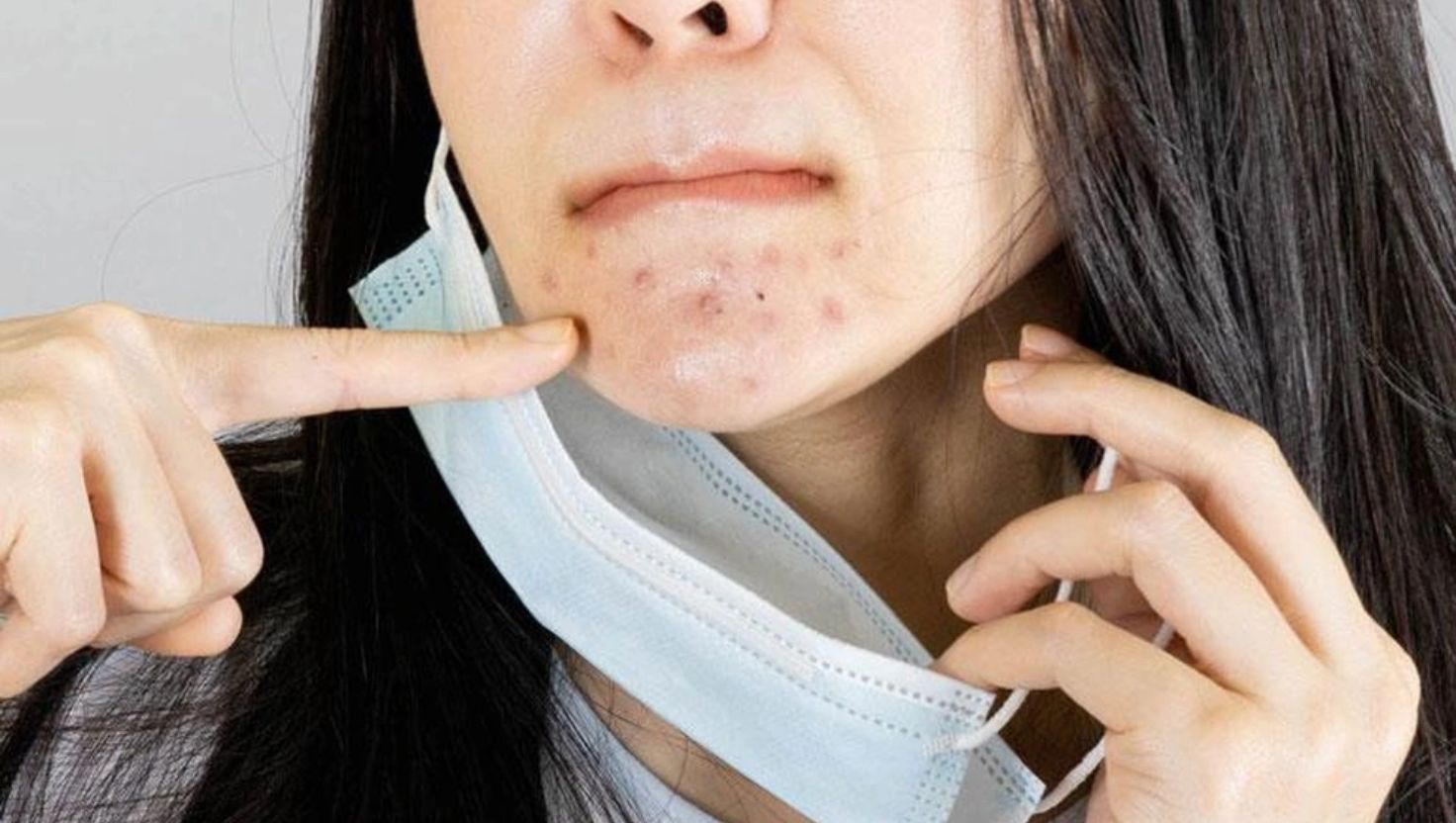 Nguyên nhân gây mụn do đeo khẩu trang y tế