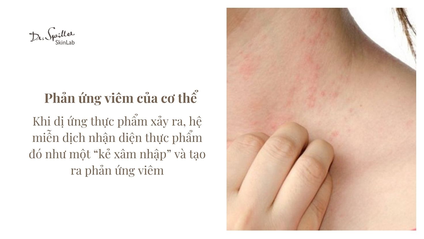 Mụn do dị ứng thực phẩm: Hiểu rõ nguyên nhân và cách xử lý