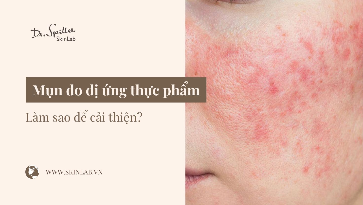 Mụn do dị ứng thực phẩm: Cách nhận biết và điều trị