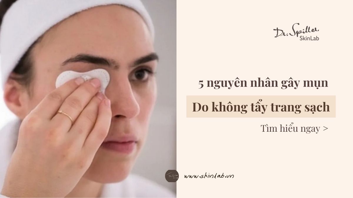 Mụn do không tẩy trang sạch