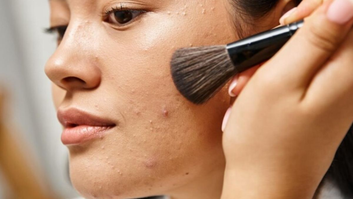 Dấu hiệu nhận biết da bị mụn do lạm dụng mỹ phẩm