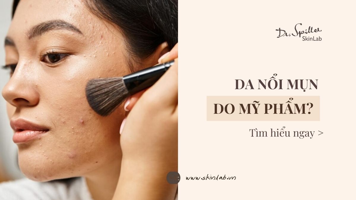 Cẩn thận: 4 lý do mỹ phẩm gây mụn trên da bạn