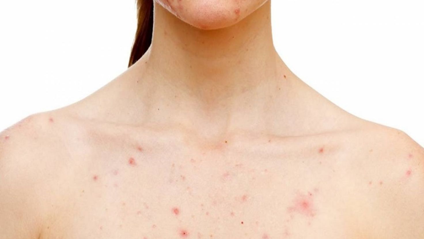 Triệu chứng thường gặp của mụn do "nóng gan"