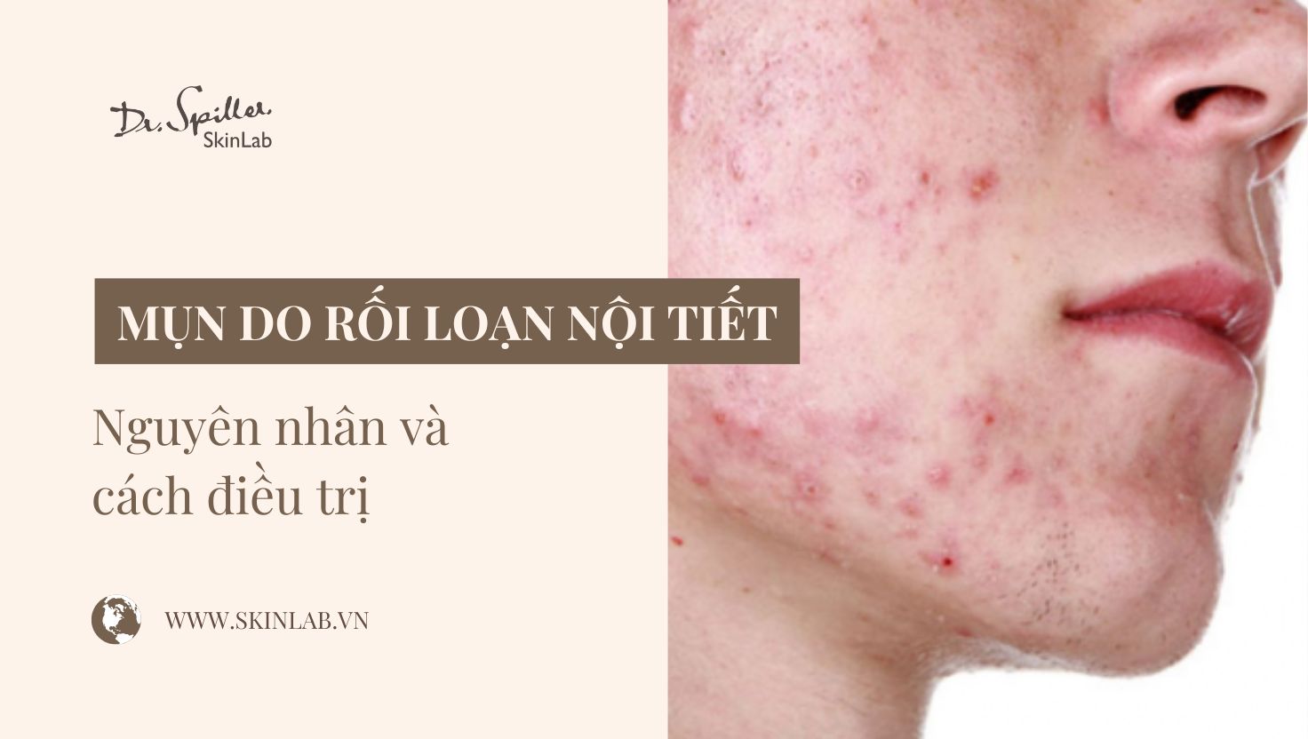 Mụn do rối loạn nội tiết: Nguyên nhân và cách điều trị hiệu quả