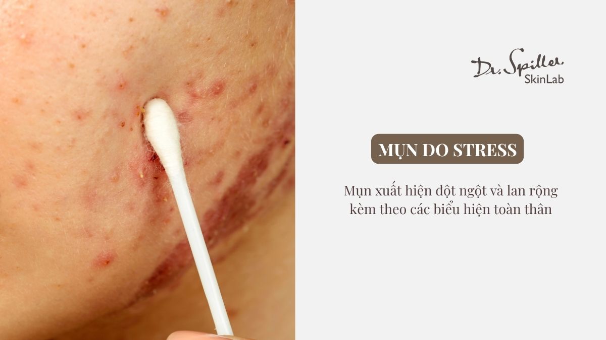 Dấu hiệu nhận biết mụn do stress kéo dài
