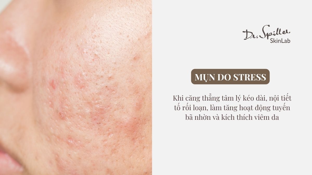 Cơ chế hình thành mụn do stress