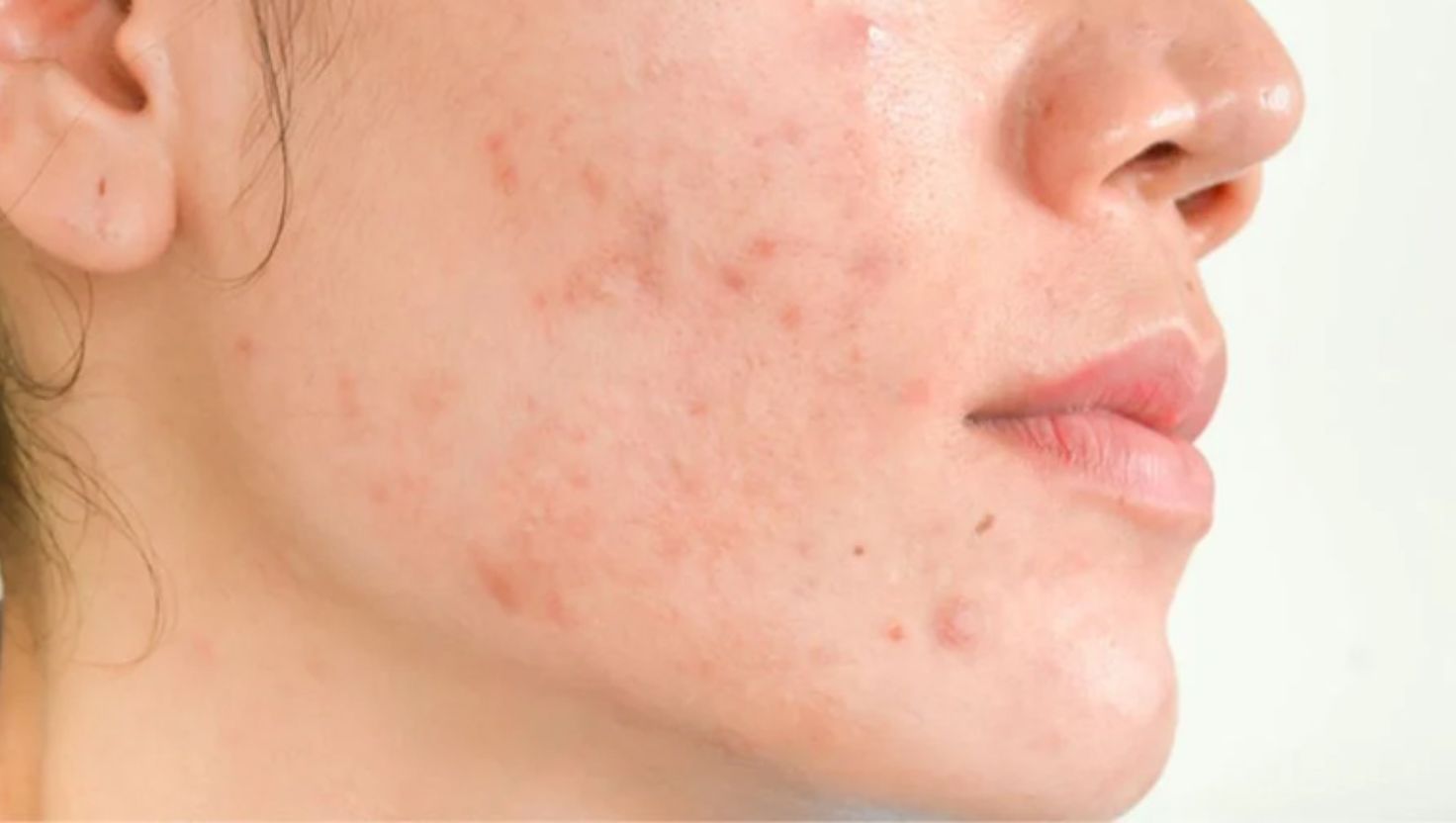 Các loại mụn thường gặp khi thời tiết thay đổi