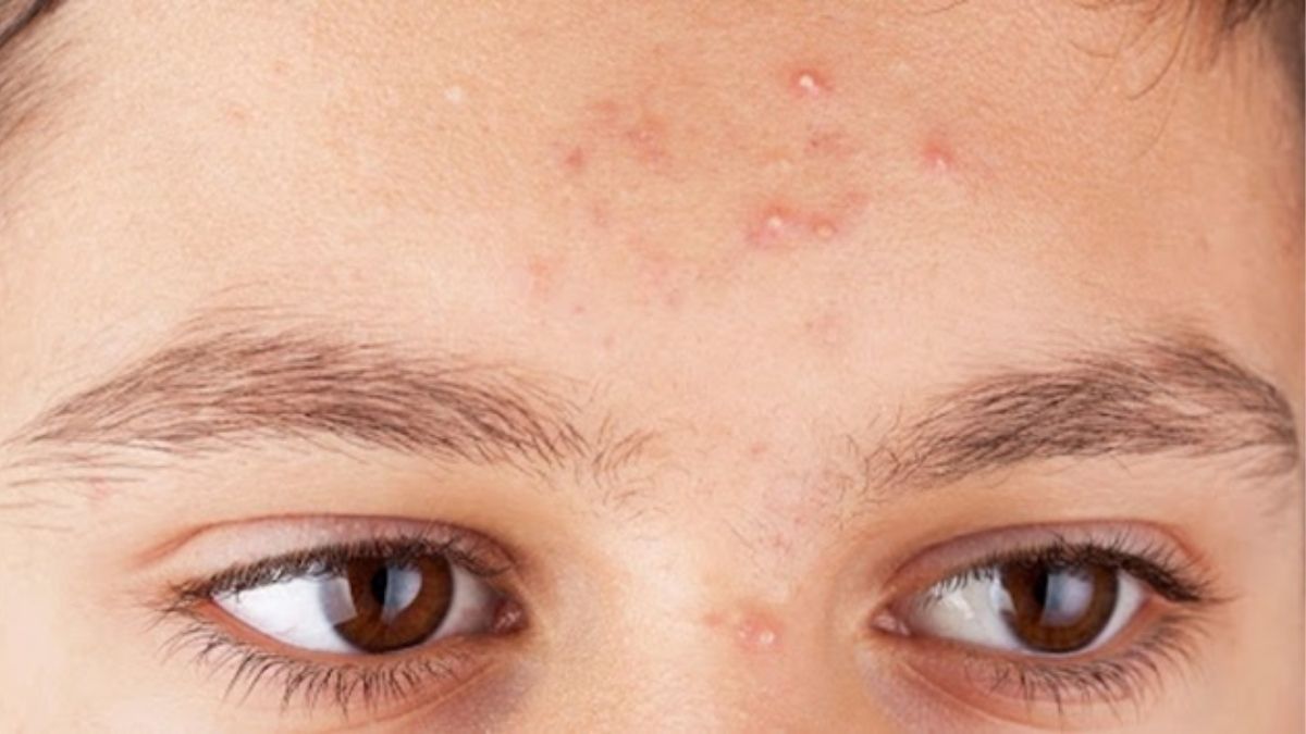 Nguyên nhân khiến thức khuya gây mụn