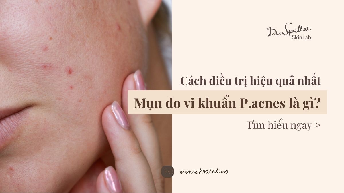 Nhận biết các dấu hiệu đặc trưng của mụn do vi khuẩn P.acnes