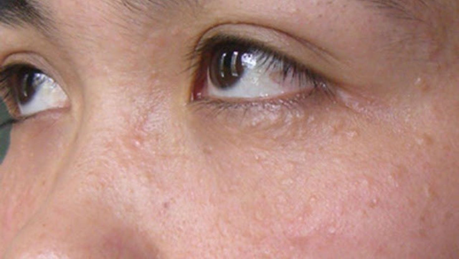 Nguyên nhân gây mụn li ti quanh mắt là gì?