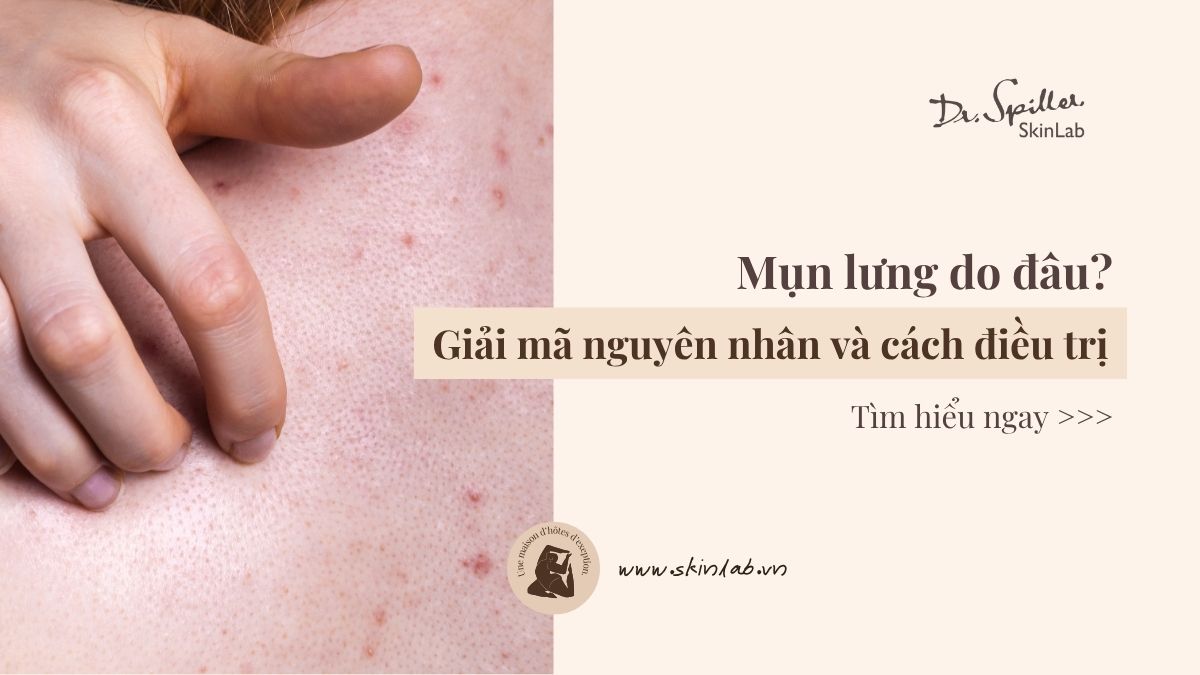 Mụn lưng do đâu? Giải mã nguyên nhân và cách điều trị
