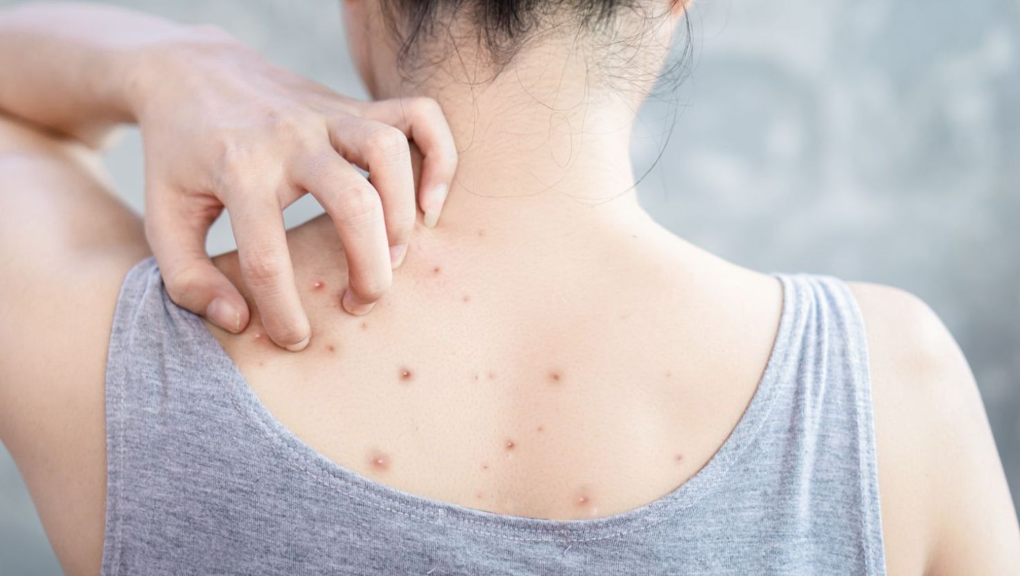 Nguyên nhân gây mụn lưng ở tuổi dậy thì nữ