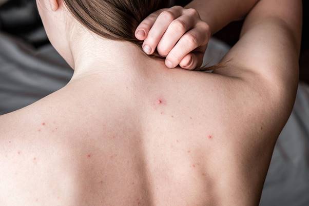 Những sai lầm phổ biến khi điều trị mụn lưng tuổi dậy thì