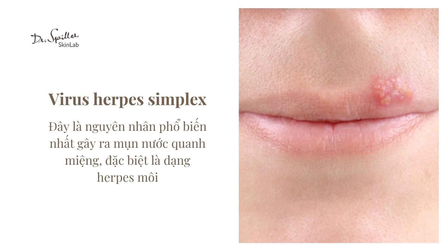 Virus HSV-1 tồn tại trong cơ thể và có thể tái hoạt động khi hệ miễn dịch suy yếu.