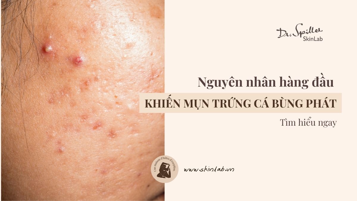 Mụn Trứng Cá Do Stress